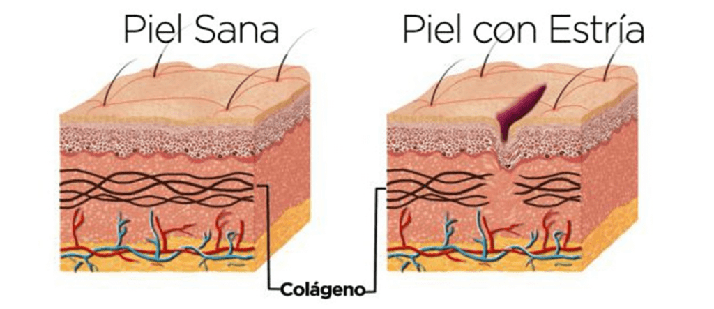 Piel sana y piel con estría