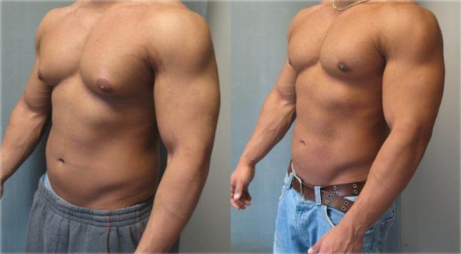 Diferencias uso de esteroides hombres